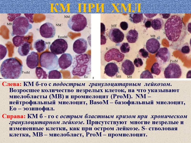 КМ  ПРИ  ХМЛ Слева: КМ б-го с подострым  гранулоцитарным  лейкозом.